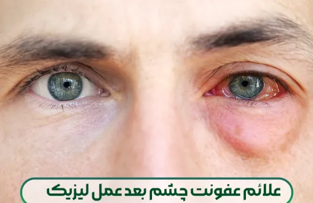 عفونت چشم بعد عمل لیزیک
