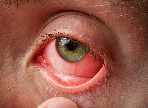 عفونت چشم بعد عمل لیزیک