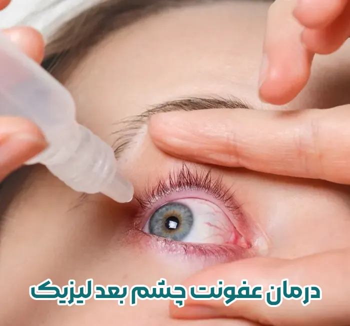 درمان عفونت چشم بعد از عمل لیزیک