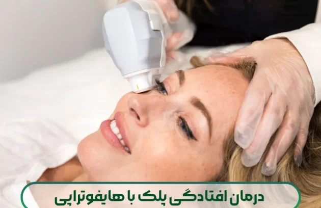 درمان افتادگی پلک با هایفوتراپی