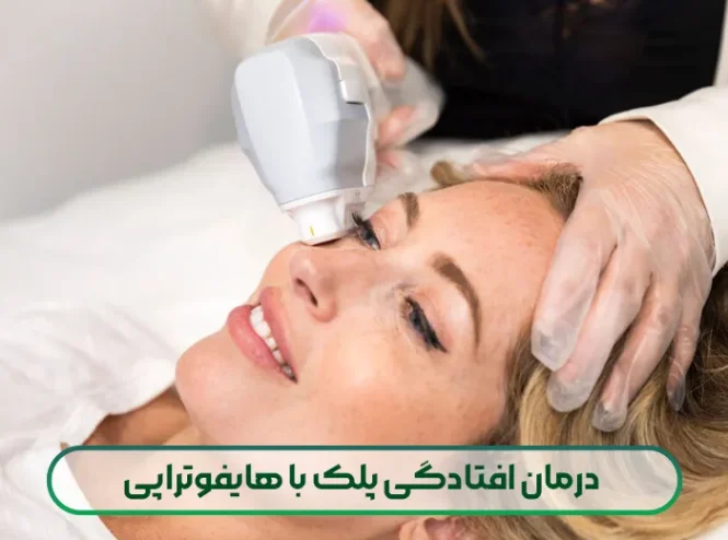 درمان افتادگی پلک با هایفوتراپی