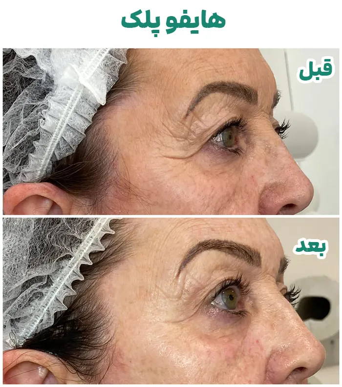درمان افتادگی پلک با هایفوتراپی