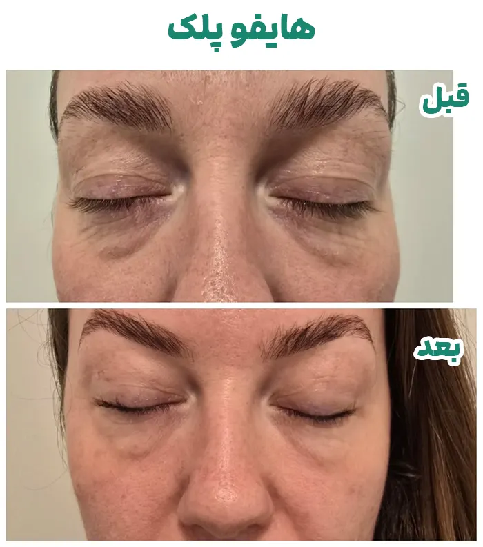 هایفوتراپی پلک