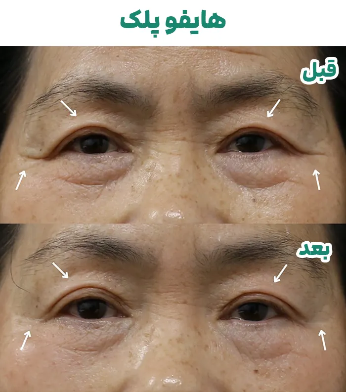 هایفوتراپی پلک