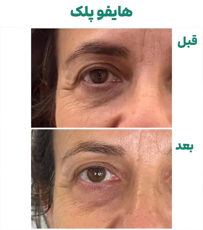 هایفوتراپی پلک