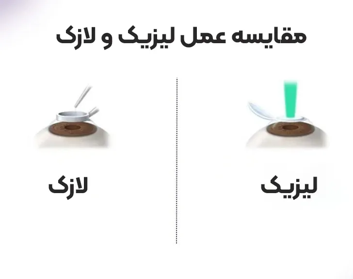 مقایسه عمل لیزیک و لازک