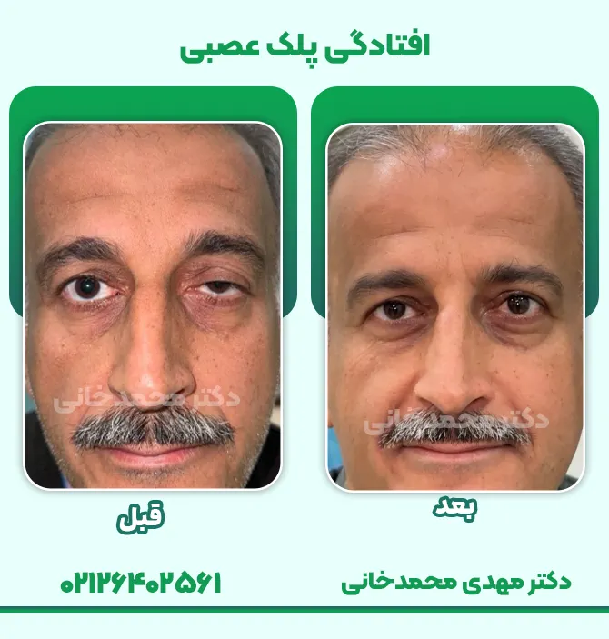 درمان افتادگی پلک عصبی