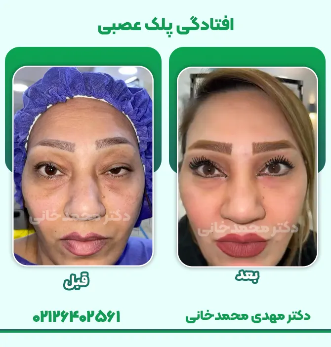 درمان افتادگی پلک عصبی