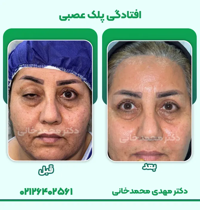 درمان افتادگی پلک عصبی