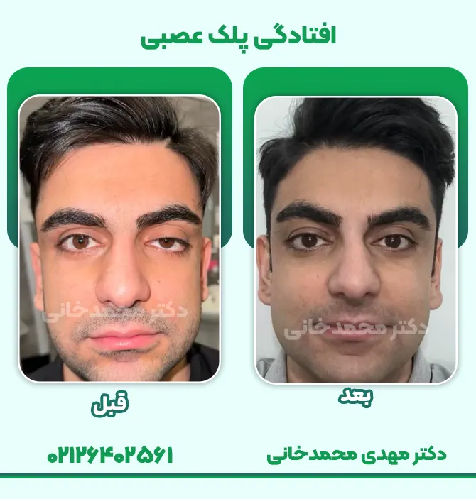 افتادگی پلک عصبی