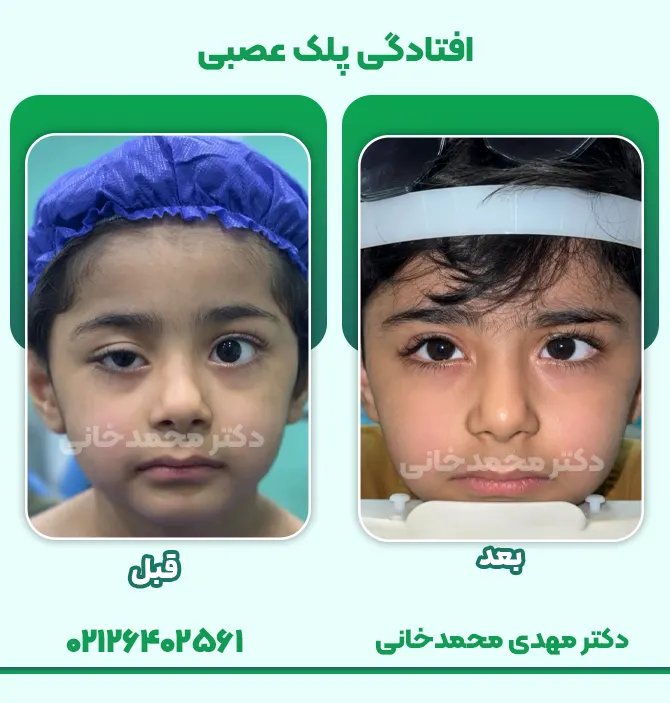 روش درمان افتادگی پلک عصبی