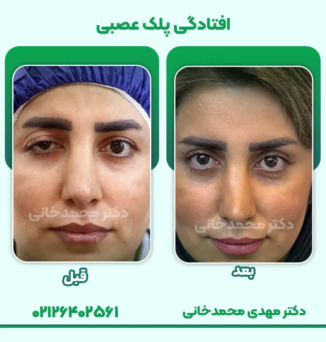 علائم افتادگی پلک عصبی