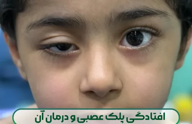 درمان افتادگی پلک عصبی