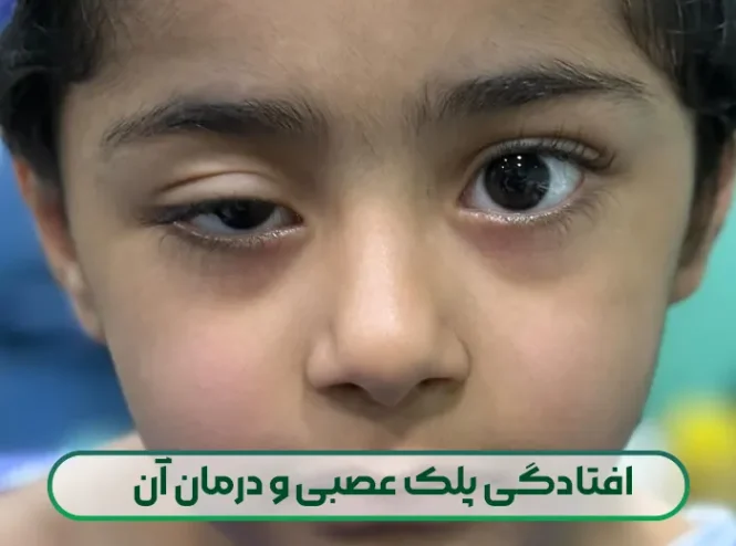 درمان افتادگی پلک عصبی