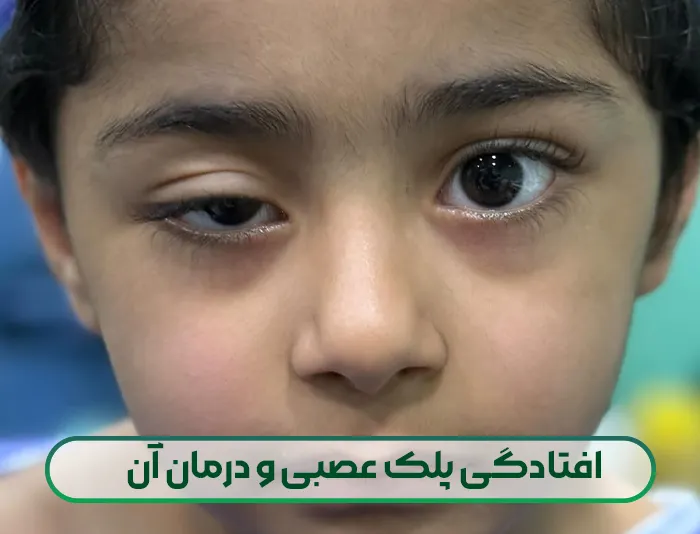 درمان افتادگی پلک عصبی