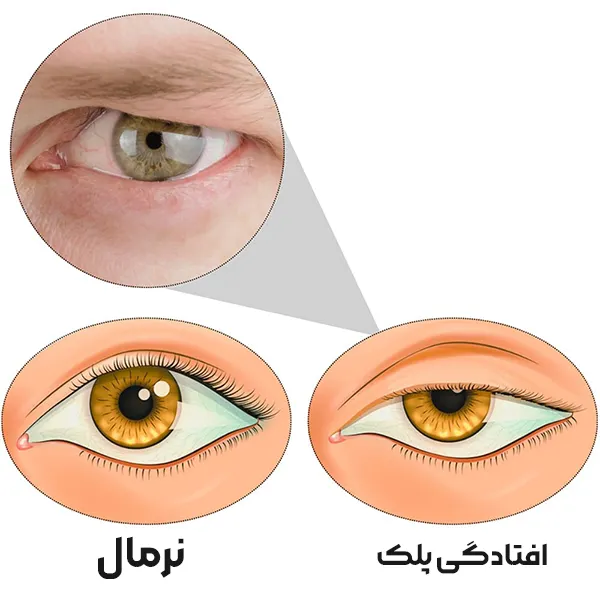 افتادگی پلک