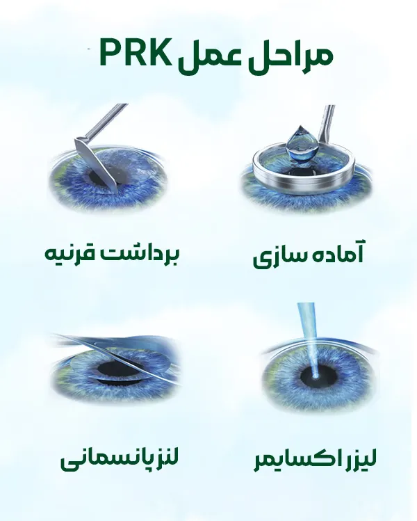 عمل prk