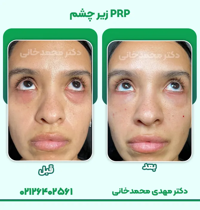 پی آر پی زیر چشم