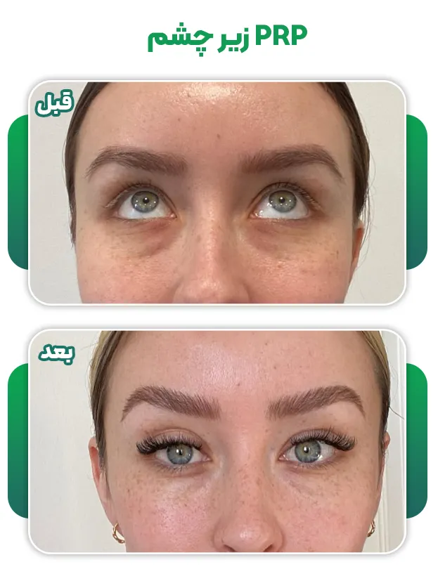 عکس قبل بعد پی آر پی زیر چشم