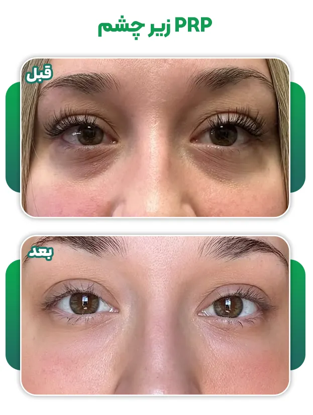 عکس قبل بعد پی آر پی زیر چشم