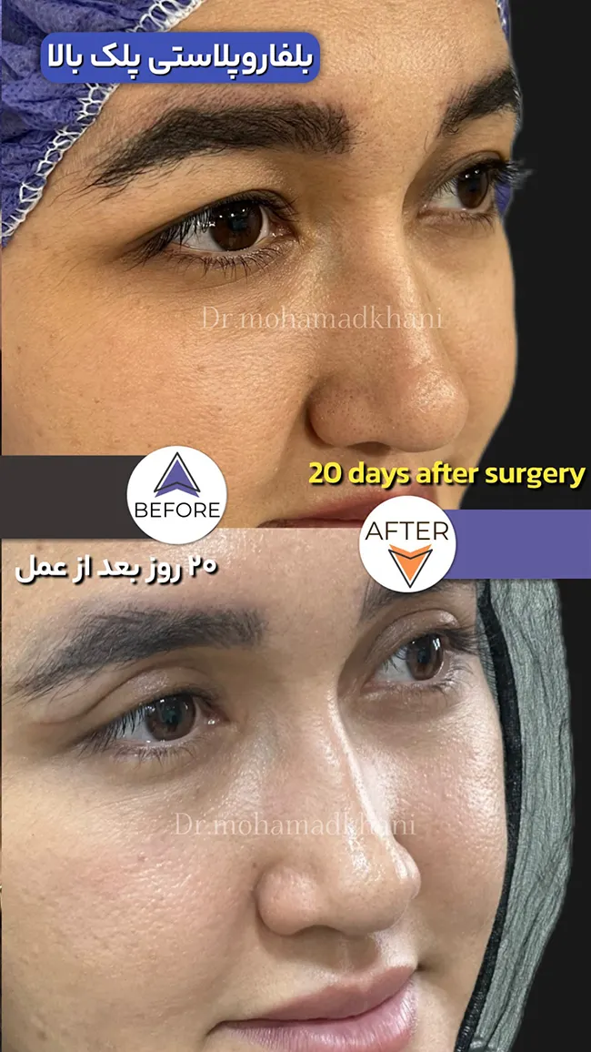 بلفاروپلاستی پلک بالا