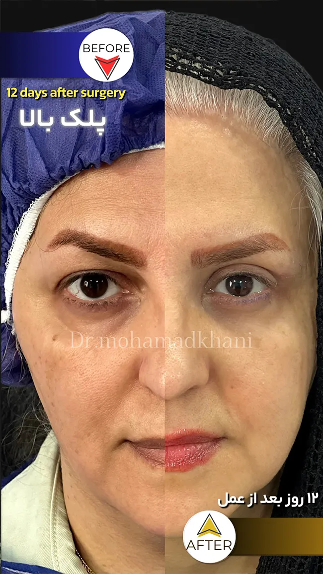 بلفاروپلاستی