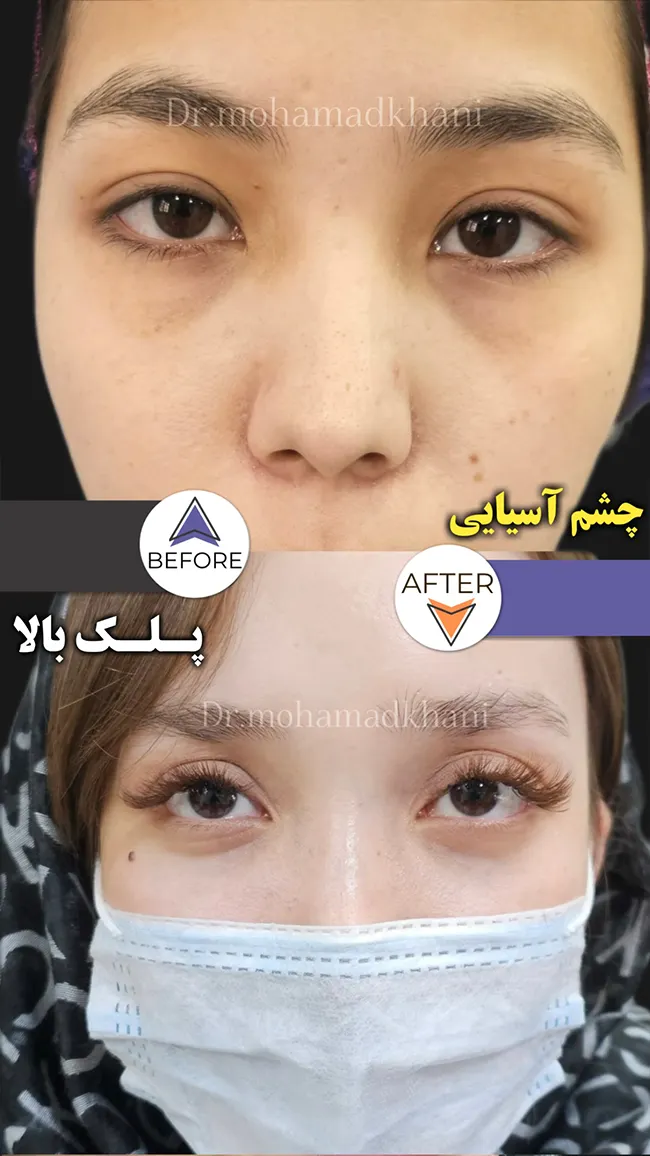 بلفاروپلاستی پلک آسیایی