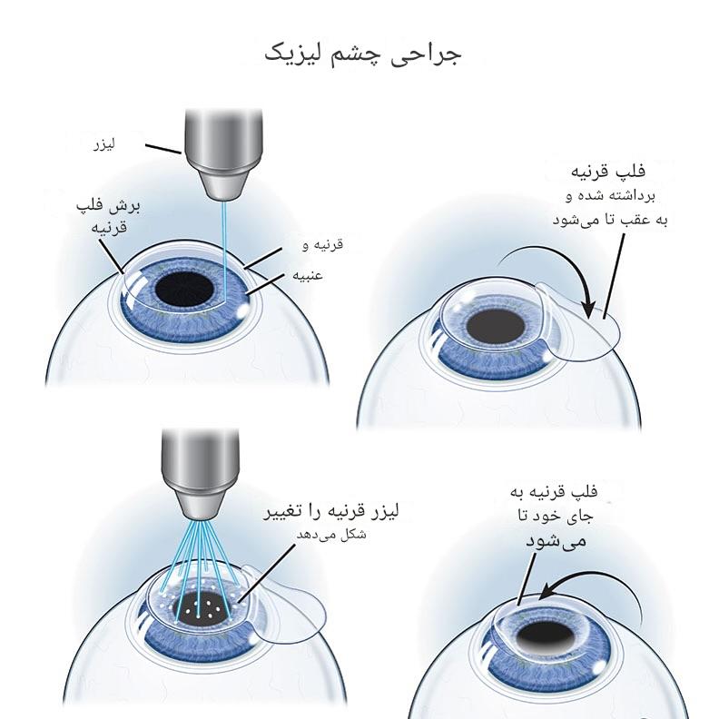 عمل لیزیک چشم