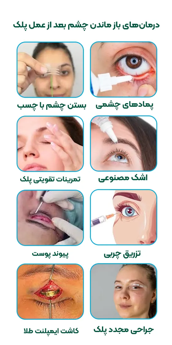 روش درمان باز ماندن چشم بعد از عمل پلک