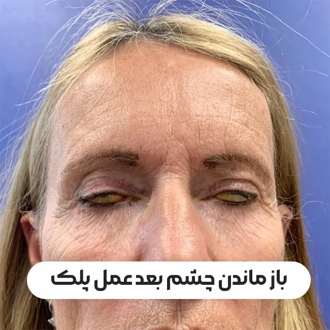 باز ماندن چشم بعد از عمل پلک
