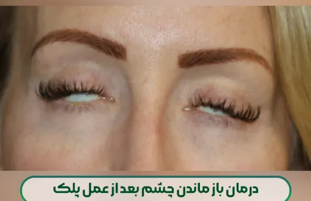 درمان باز ماندن چشم بعد از عمل پلک