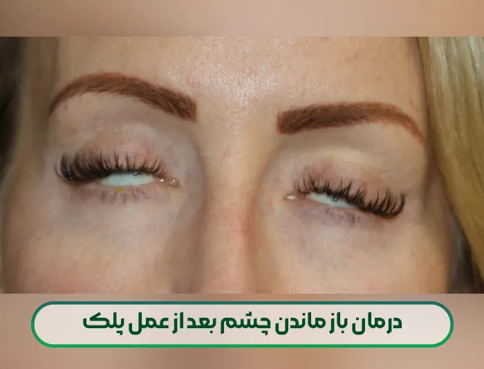 درمان باز ماندن چشم بعد از عمل پلک