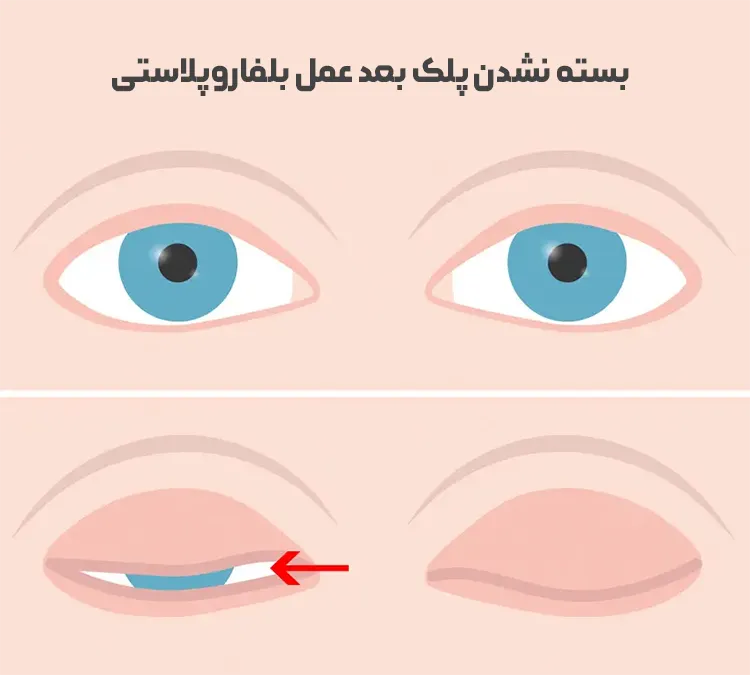 بسته نشدن چشم بعد عمل بلفاروپلاستی