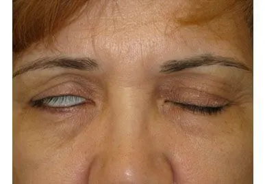 بازماندن چشم بعد عمل بلفاروپلاستی