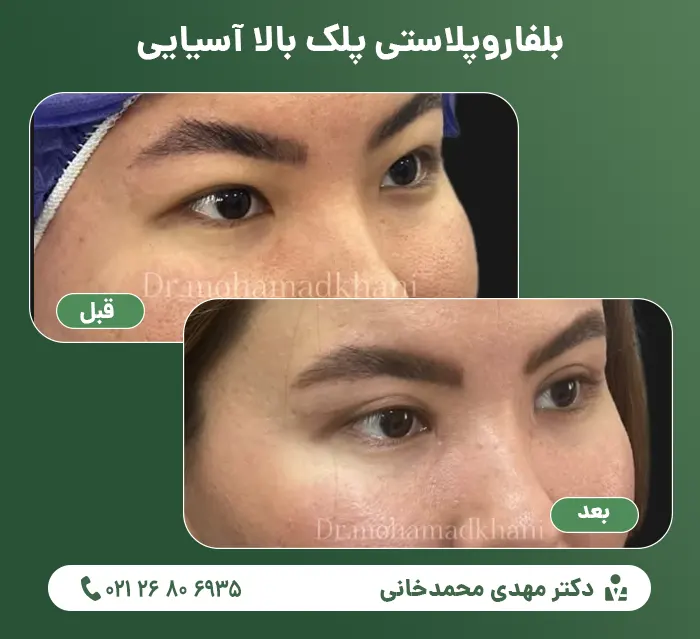 Asian upper eyelid blepharoplasty