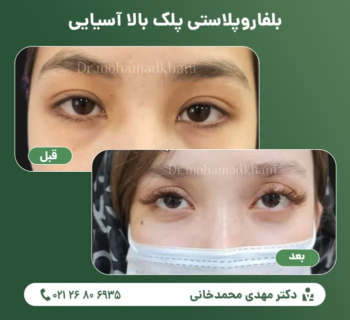 Asian upper eyelid blepharoplasty1
