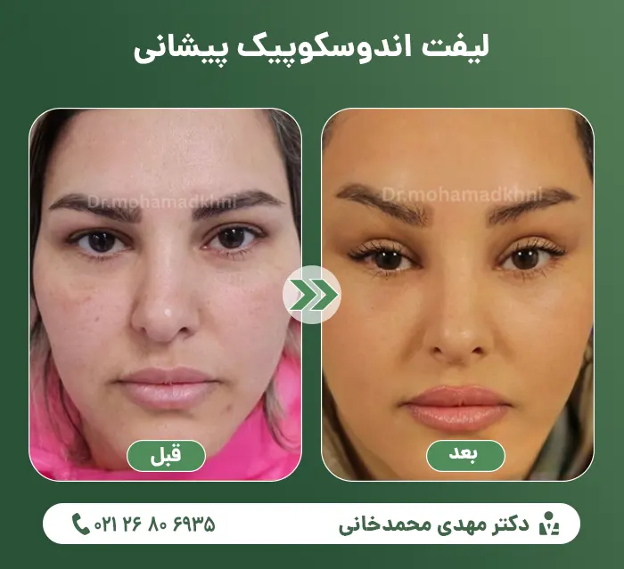 Endoscopic forehead lift-4