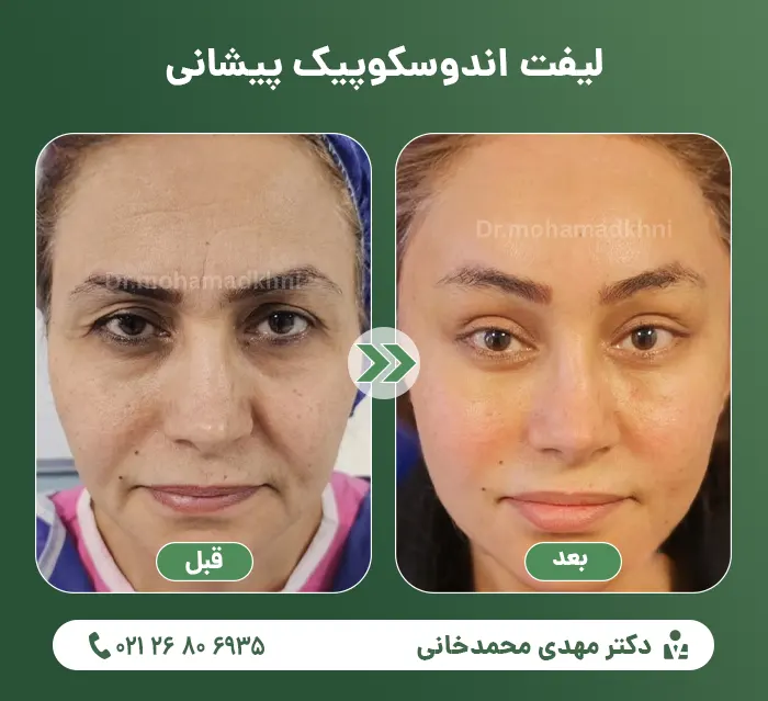 Endoscopic forehead lift-6