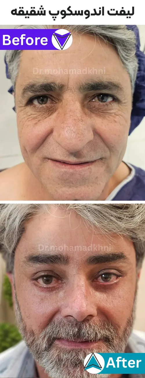 لیفت اندوسکوپ شقیقه