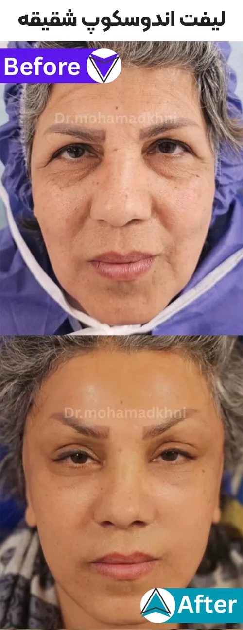 لیفت اندوسکوپ شقیقه