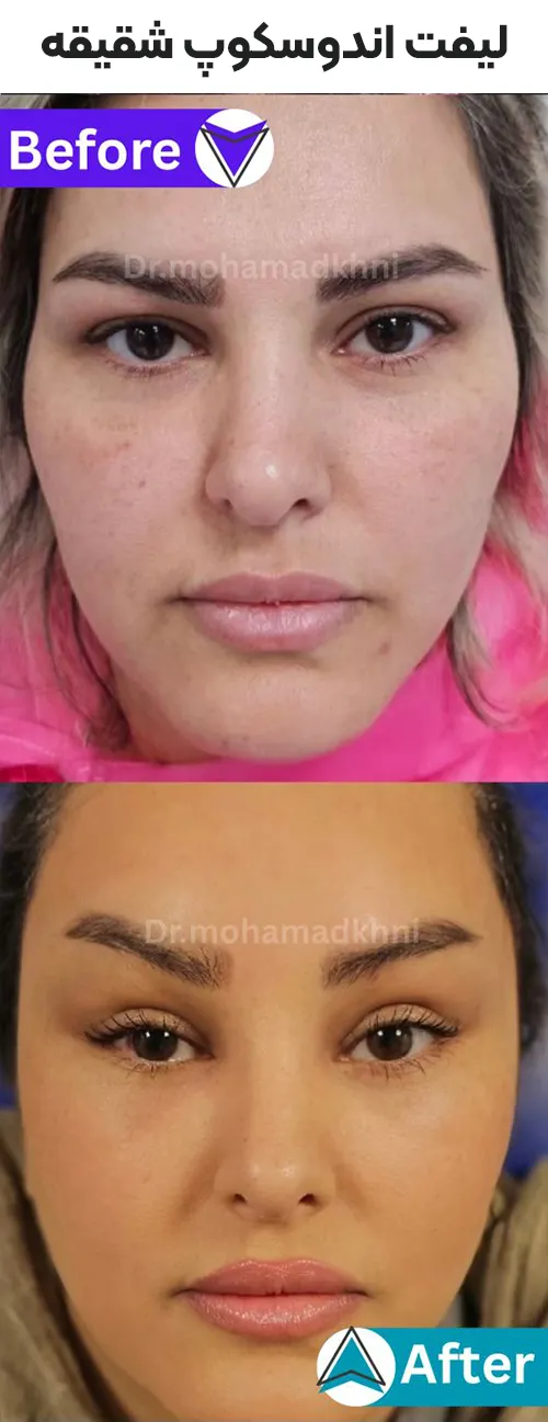 لیفت اندوسکوپ شقیقه