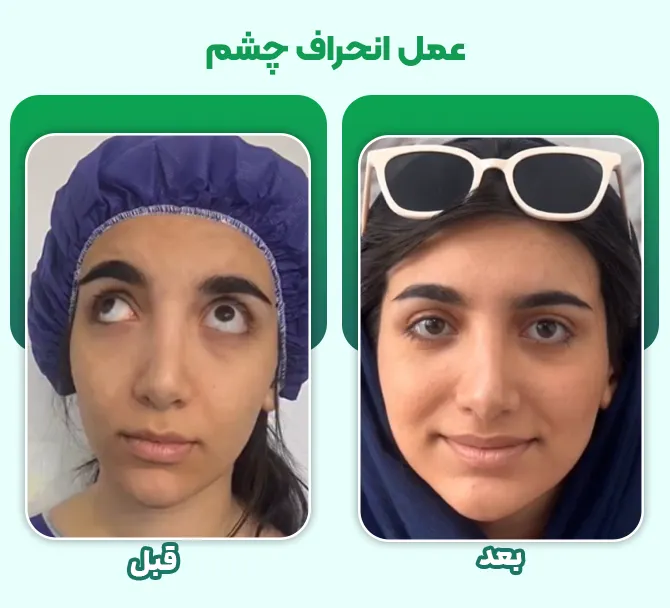 عمل انحراف چشم