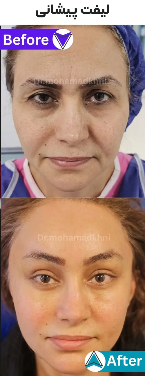 لیفت پیشانی