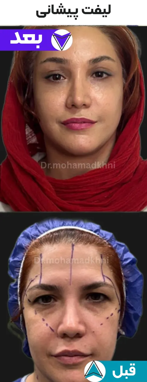 لیفت پیشانی