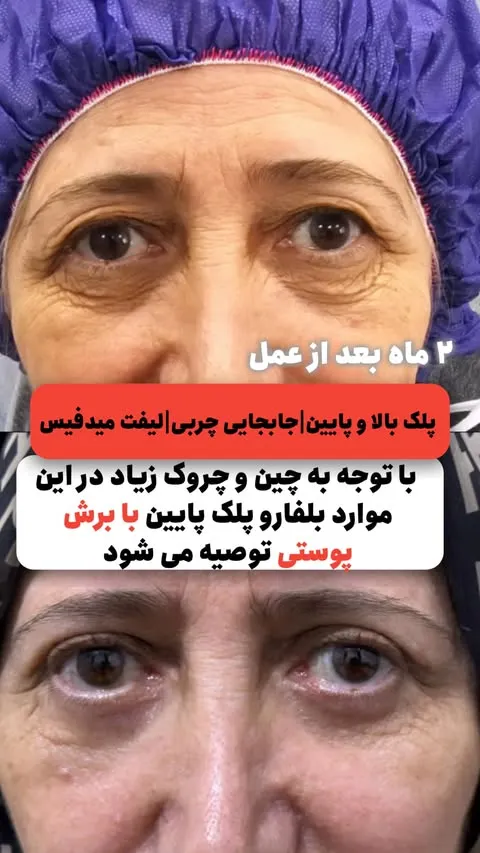 بلفاروپلاستی پلک پایین