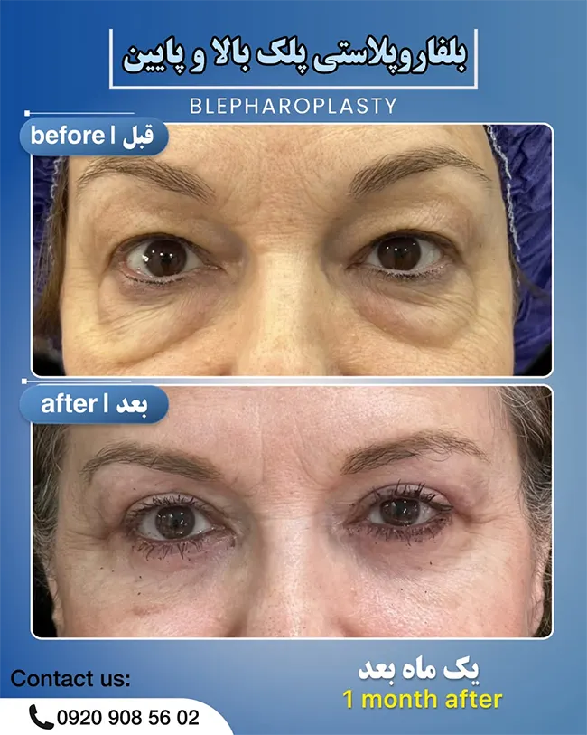 بلفاروپلاستی پلک زیر چشم