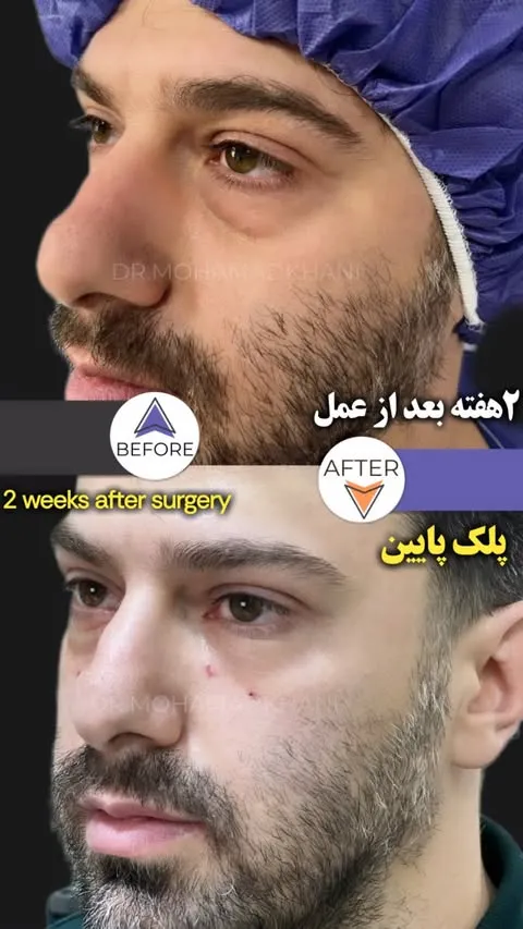 بلفاروپلاستی پلک زیر چشم