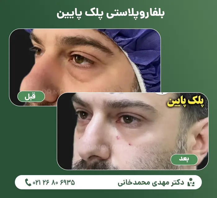 Lower eyelid blepharoplasty2