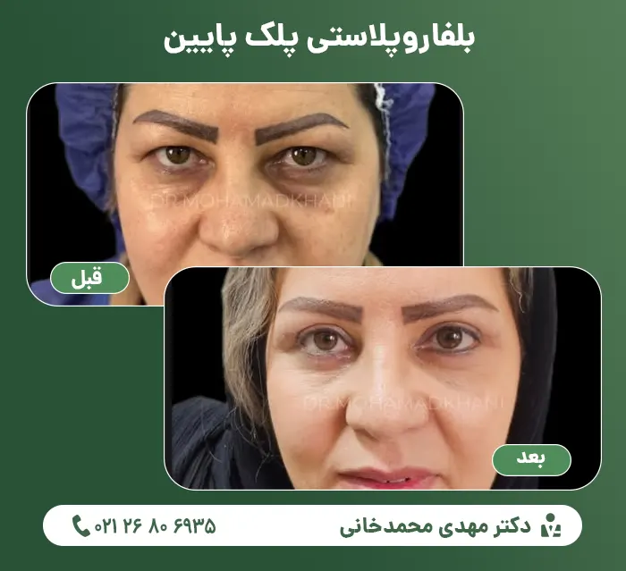 Lower eyelid blepharoplasty3