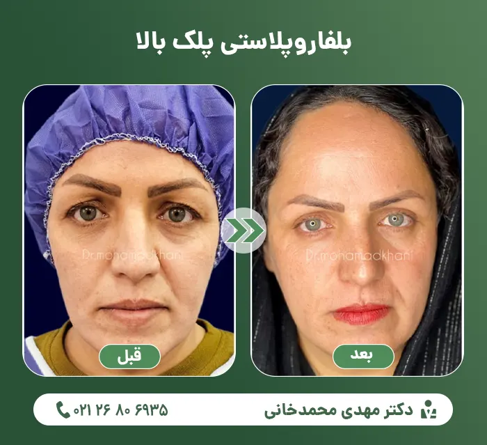 Upper eyelid blepharoplasty-1